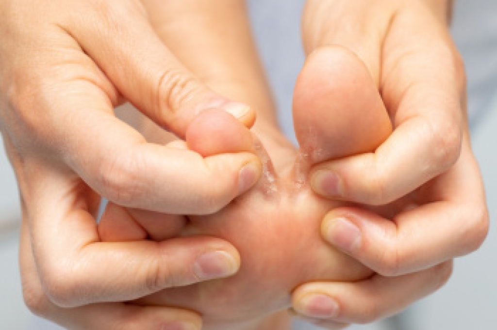 Types and Causes of Athlete’s Foot