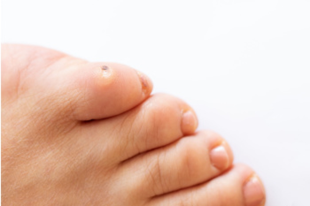 How a Podiatrist Can Help With Corns and Calluses