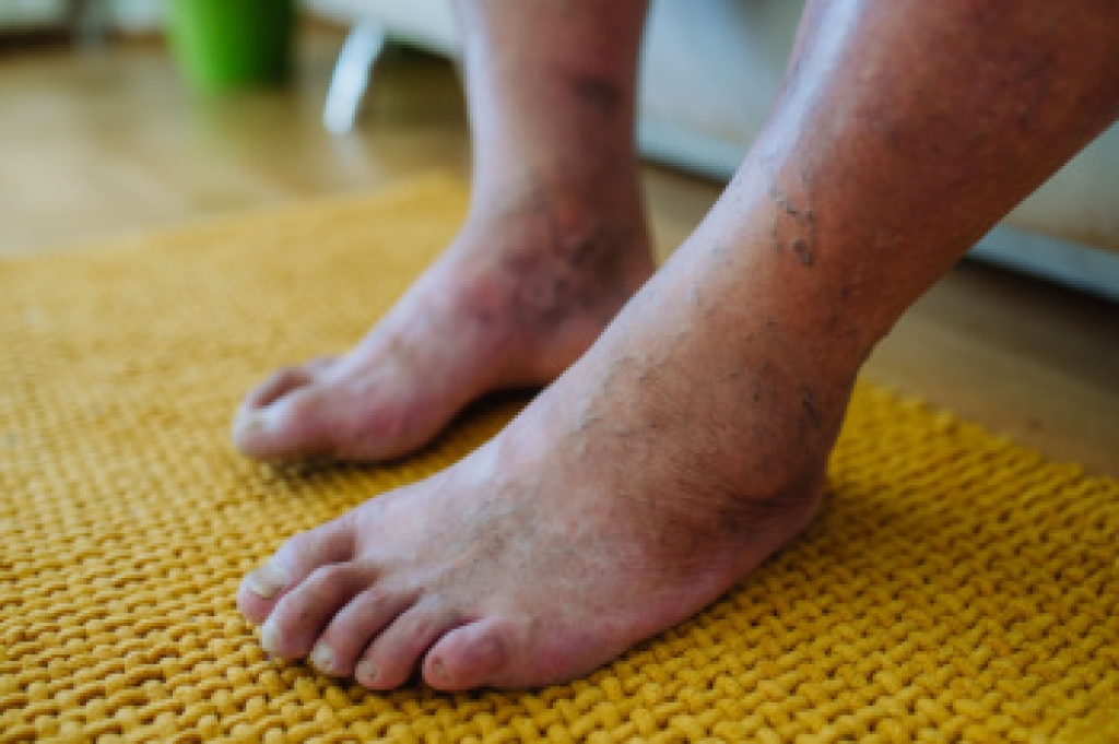 Podiatrists Help Diabetic Patients Prevent Limb Loss