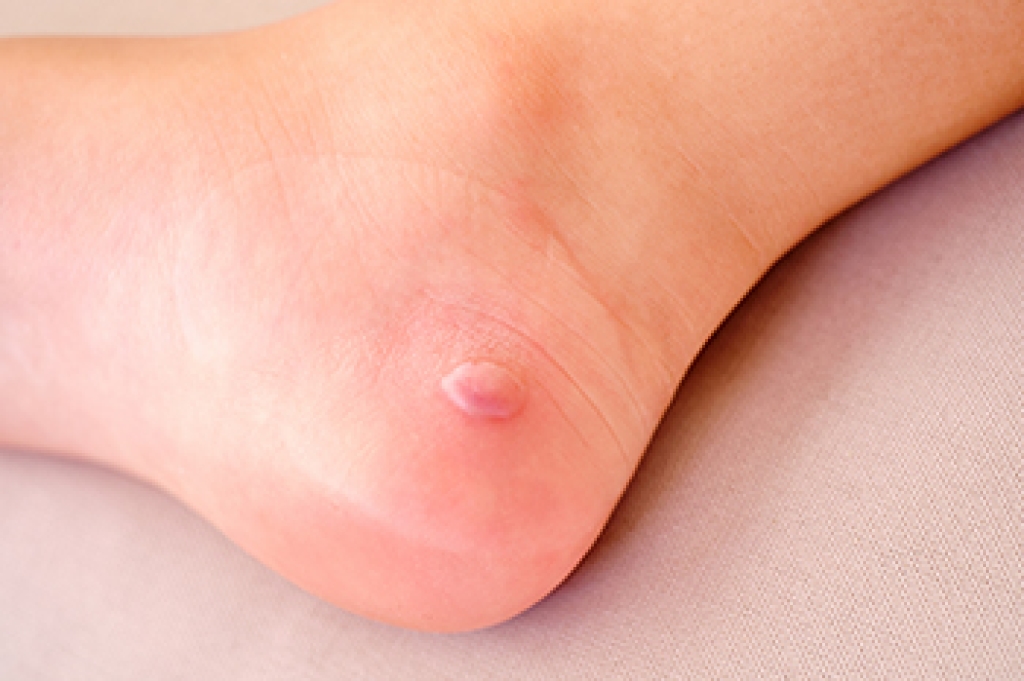 Diabetic Foot Blisters and What They Look Like
