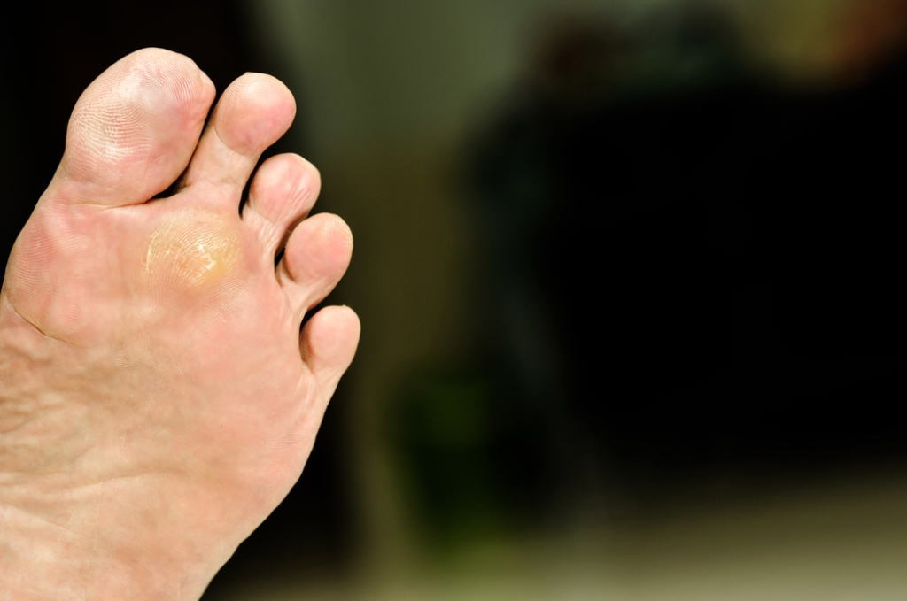 Recognizing and Finding Relief From Plantar Warts