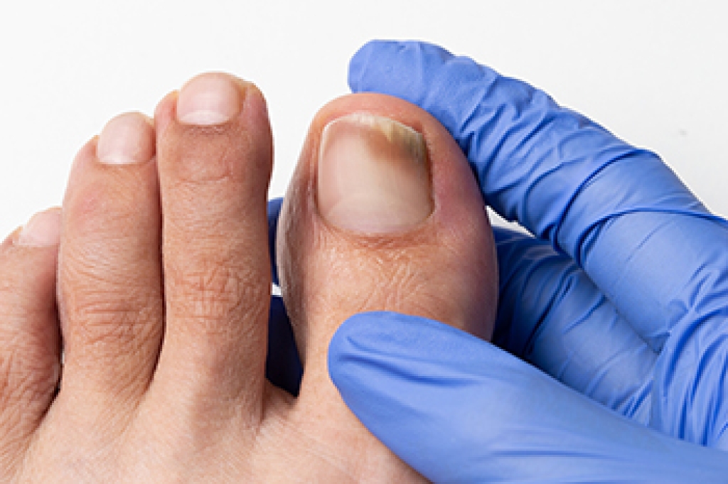 Types of Fungal Toenail Infections